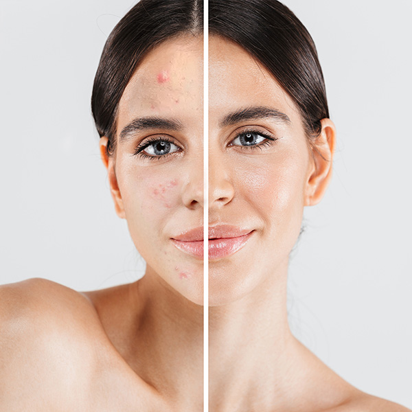 Schäumende Waschcreme | Med+ Anti-Spot Schäumende Waschcreme | Med+ Anti-Spot