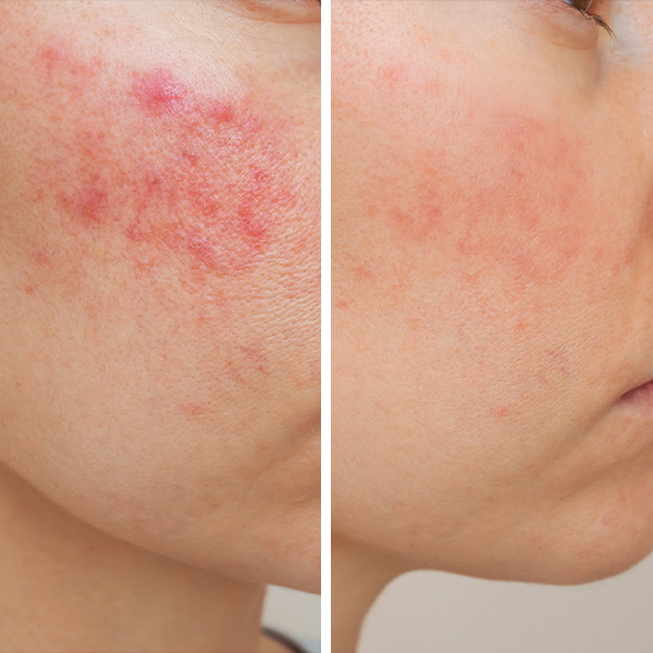 Couperose Konzentrat | Med+ Anti-Red Couperose Konzentrat | Med+ Anti-Red