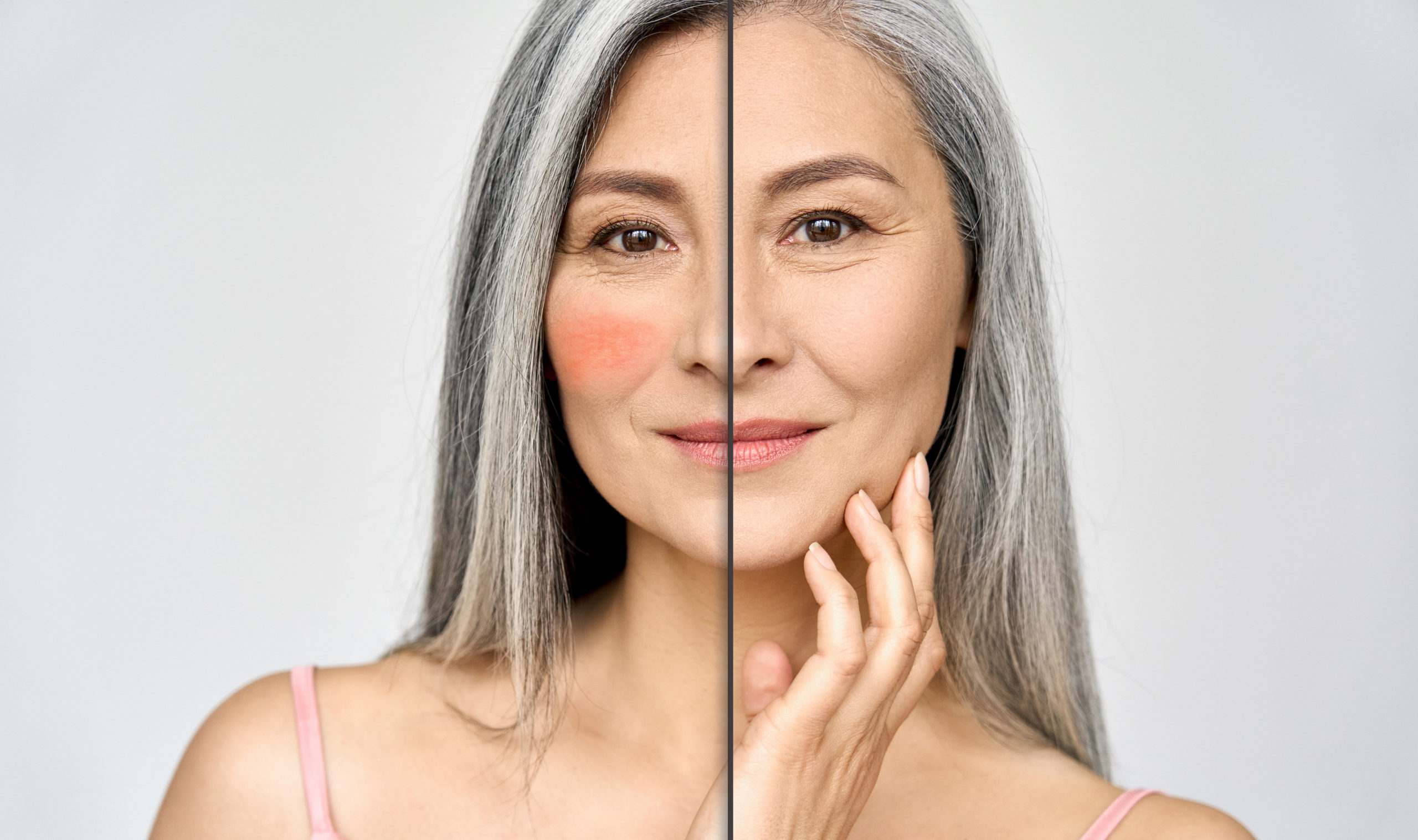 Rötungen, Couperose und Rosacea
